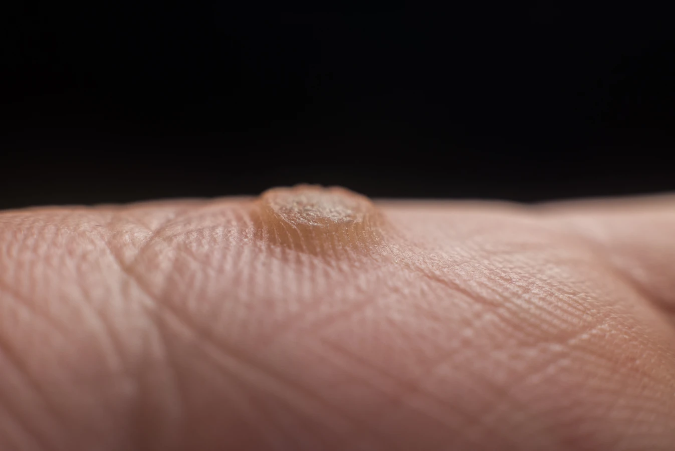 Co wywołuje kurzajki?